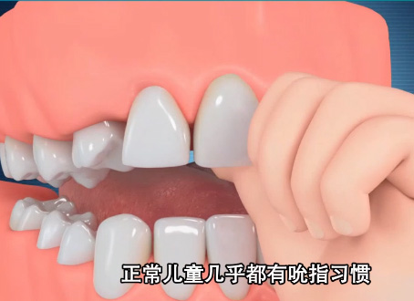 兒童不良習(xí)慣吸吮手指