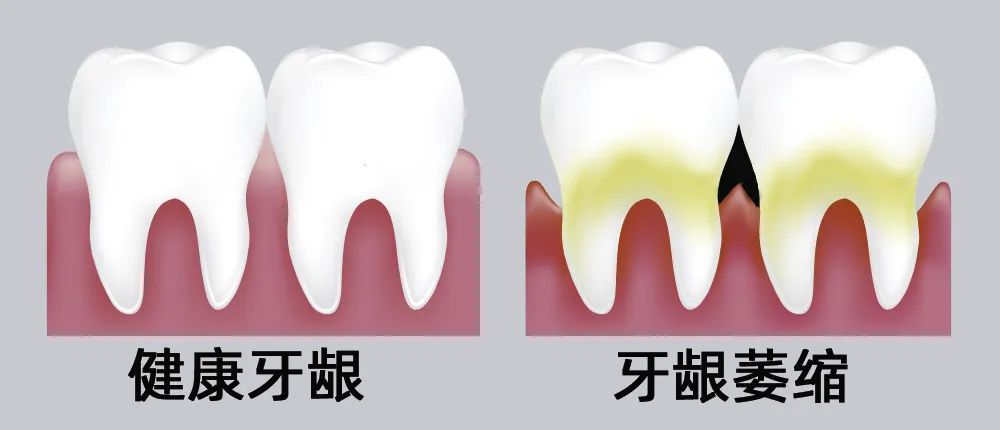 牙縫大露出“黑三角”，既塞牙又難看！還能恢復嗎？